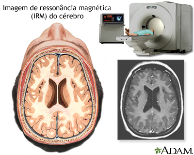 Ressonância magnética do cérebro