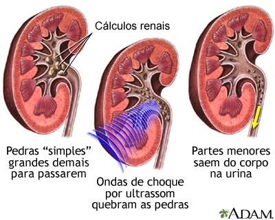 Procedimento de litotripsia