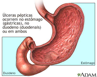 Localização de úlceras pépticas