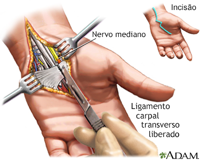 Procedimento cirúrgico do túnel carpal