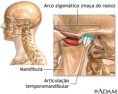 Causas de cefaleia secundária