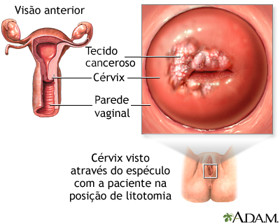 Câncer cervical