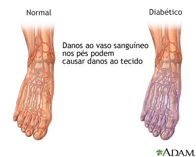 Circulação sanguínea diabética no pé
