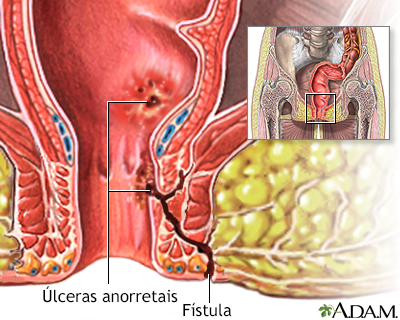 Fístulas anorretais