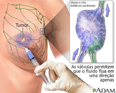 Biópsia de linfonodo sentinela