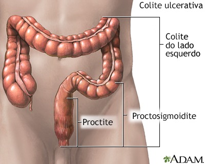 Colite ulcerativa