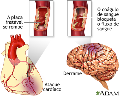 Formação de placa nas artérias