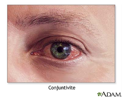 Conjuntivite