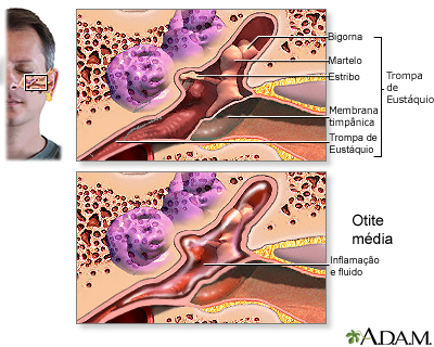 Infecção no ouvido médio (otite média)