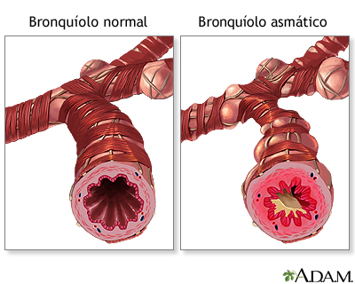 Bronquíolo normal versus asmático