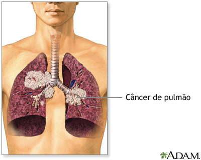 Fumo passivo e câncer de pulmão