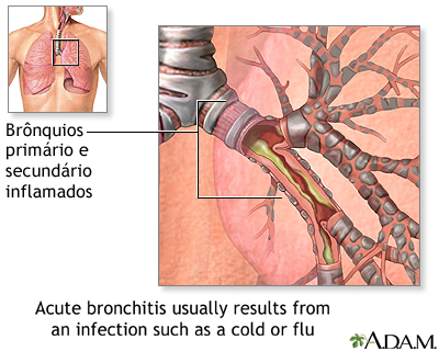 Causas da bronquite aguda