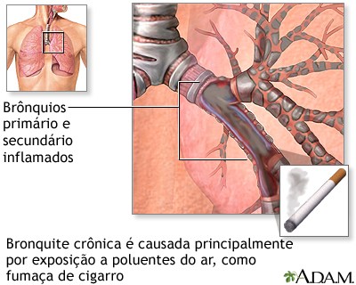 Causas da bronquite crônica