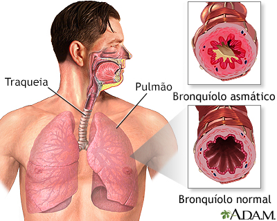 Bronquíolo asmático e bronquíolo normal