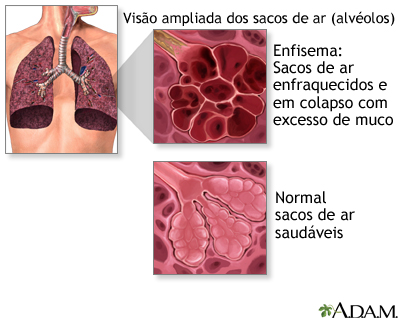 DPOC (doença pulmonar obstrutiva crônica)