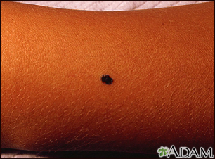 Melanoma juvenil benigno