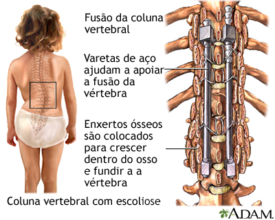 Fusão da coluna vertebral