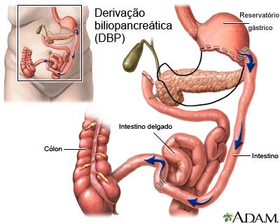 Derivação biliopancreática (DBP)