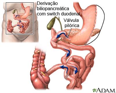 Derivação biliopancreática com switch duodenal