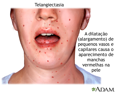 Telangiectasia