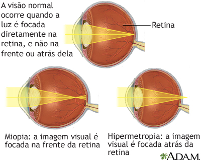 Visão normal, miopia e hipermetropia