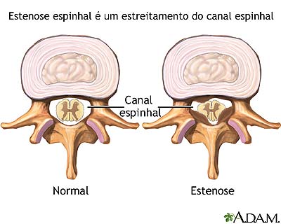 Estenose espinhal