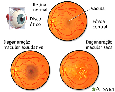 Degeneração macular