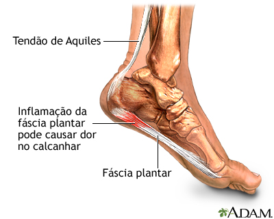 Fascite plantar