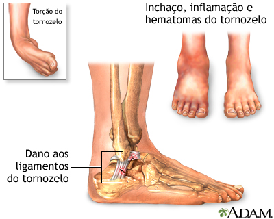 Entorse no tornozelo