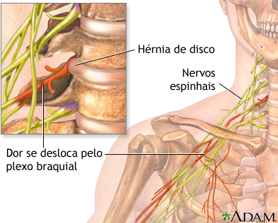 Dor no pescoço