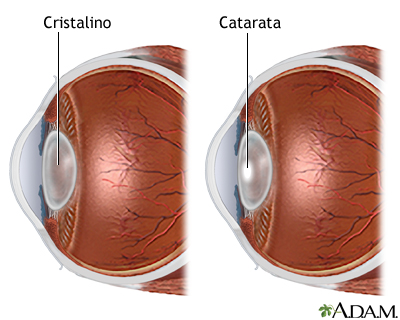 Catarata