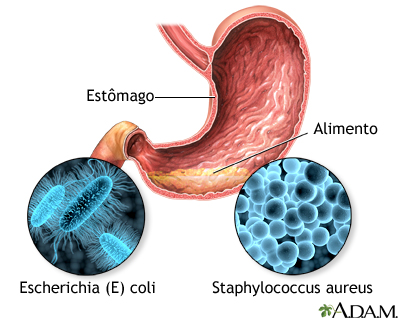 Intoxicação alimentar