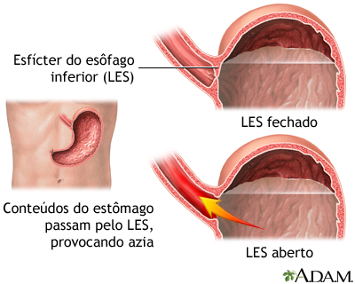 Doença do refluxo gastroesofágico