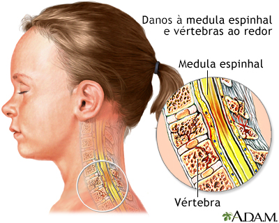 Lesão na medula espinhal