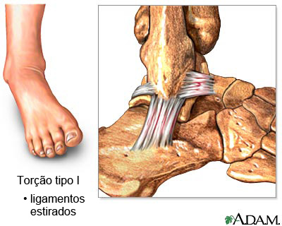 Torção do tornozelo tipo I