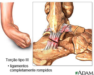 Torção do tornozelo tipo III