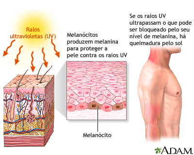 Queimadura solar