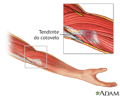 Tendinite