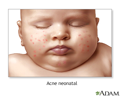 Acne em bebês