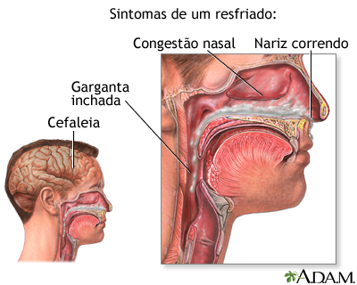 Sintomas de resfriado