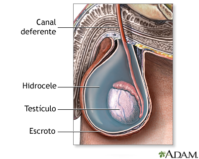 Hidrocele