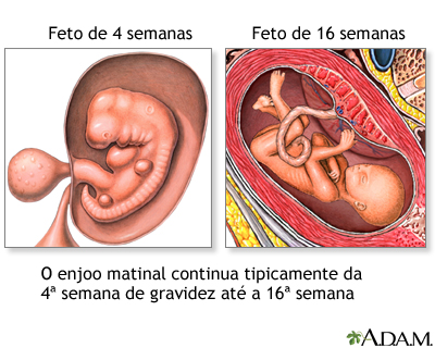 Mal-estar matinal