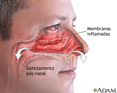 Nariz entupido e escorrendo