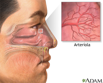 Sangramento nasal