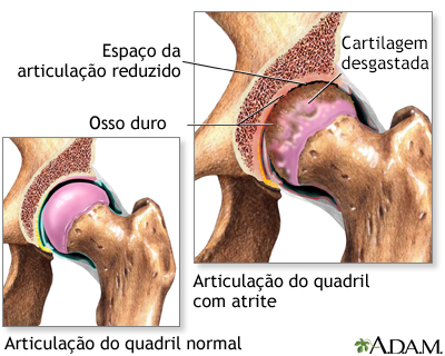 Artrite no quadril