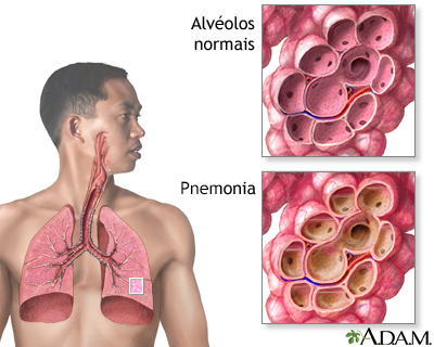 Pneumonia