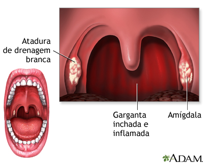 Faringite estreptocócica