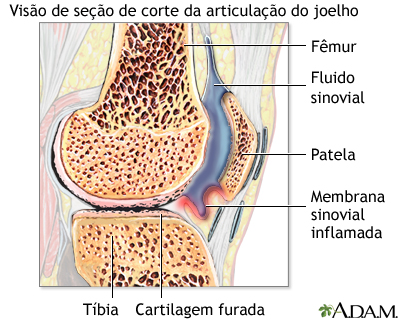 Artrite reumatoide