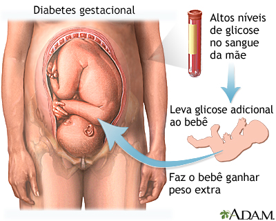 Diabetes gestacional