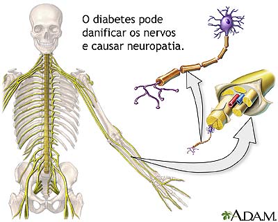 Diabetes e danos nos nervos